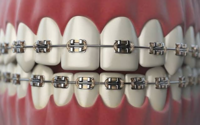 All Your Conventional Braces Questions Answered: A Complete Guide