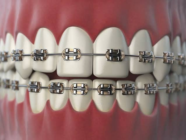 All Your Conventional Braces Questions Answered: A Complete Guide