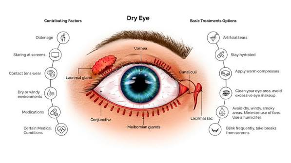 New Cyclosporine Ophthalmic Solution Demonstrates Significant Efficacy in Improving Signs of Dry Eye Disease